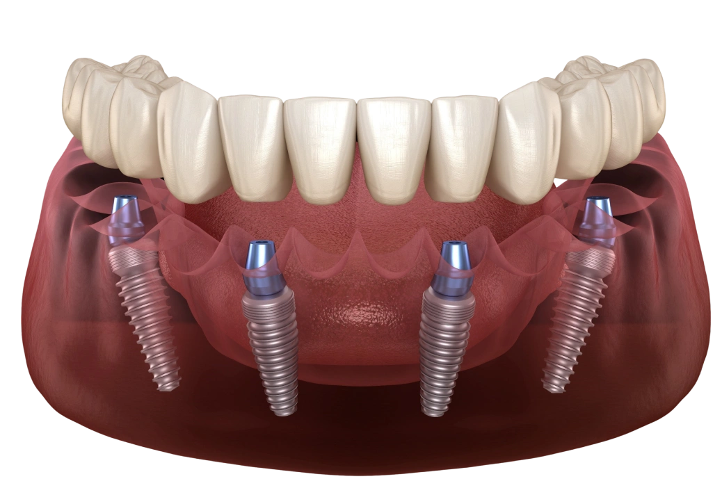 Dental implant model showing prosthetic teeth mounted on four implants in jawbone.